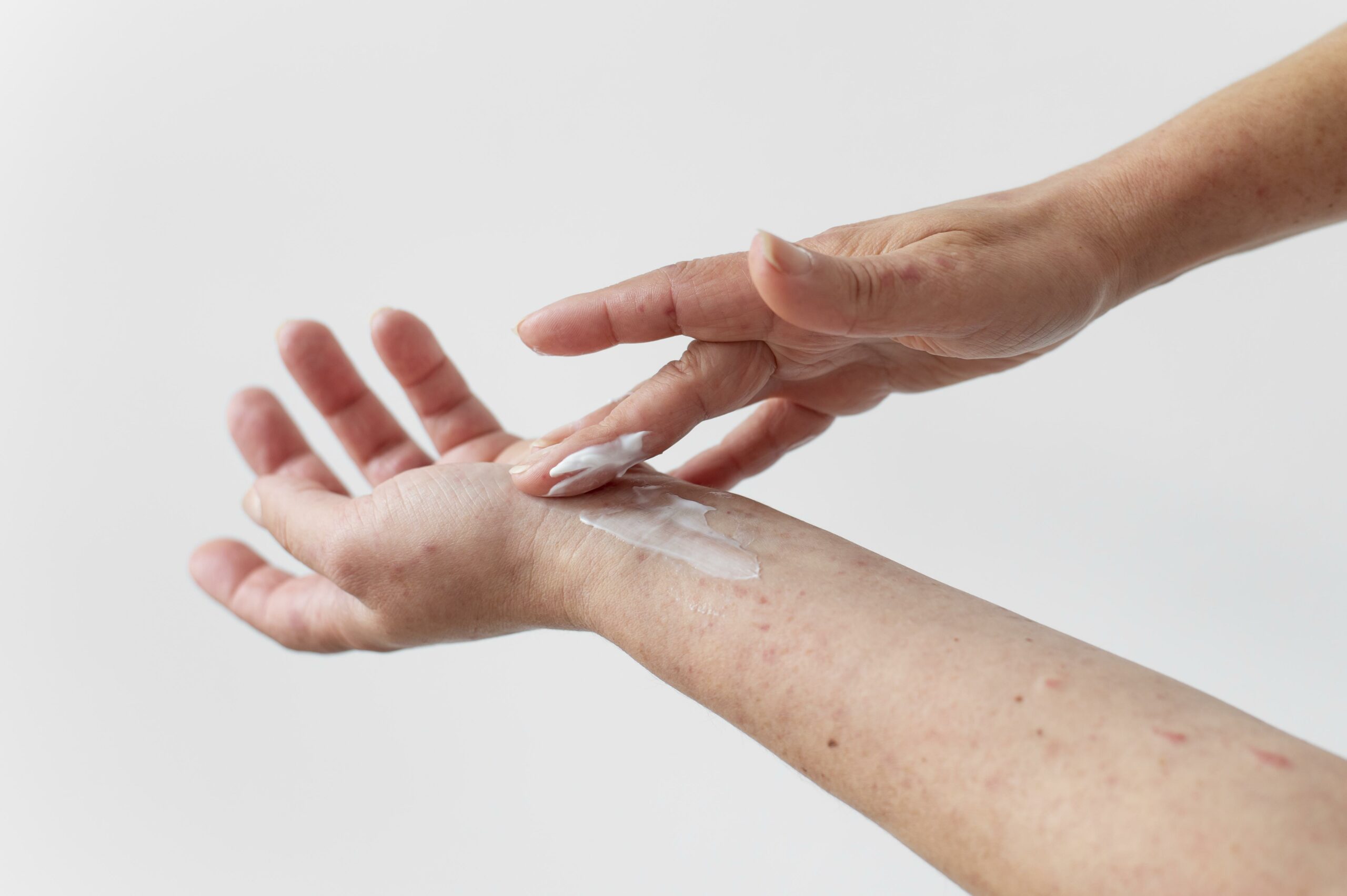 alergia-skorna-na-ramieniu-osoby une réaction cutanée